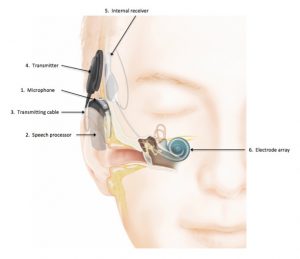 Cochlear implant